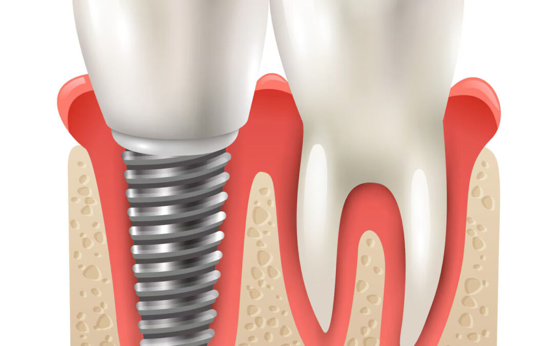 dental implant benefits functional advantages of implants